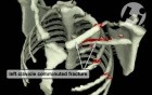 Volumated Ribs and Clavicle