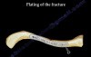 Clavicle Fracture - Video Lecture
