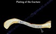 Clavicle Fracture - Video Lecture