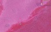 Acute infarct - Spleen - Histopathology