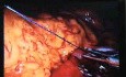 Jejunal Gastrointestinal Stromal tumor (GIST) (67 of 86)