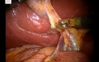 Robotic Cholecystectomy