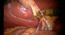 Robotic Cholecystectomy