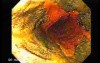 Barrett Esophagus - endoscopic view  (5 of 9)