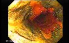 Barrett Esophagus - endoscopic view  (5 of 9)