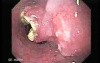 Small cell carcinoma of the lung that invades the upper and the middle third of the Esophagus (4 of 7)
