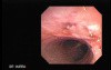 Tracheal Endoscopy - main carina 3/5