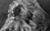 Diffuse Adenocarcinoma with signet ring cells (10 of 18)