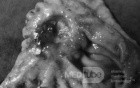 Diffuse Adenocarcinoma with signet ring cells (10 of 18)