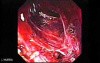 Adenocarcinoma of the Gastroesophageal Junction - a Small Fistula Tract