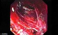 Adenocarcinoma of the Gastroesophageal Junction - a Small Fistula Tract