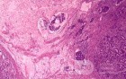Adenocarcinoma of the Antrum and incisura angularis (12 of 12)