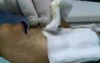 Rhinoplasty - Long nose