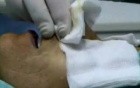 Rhinoplasty - Long nose