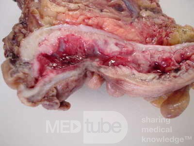 Rectal Adenocarcinoma (3 of 7)
