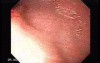 Colonic Interposition for Esophageal Substitution (8 of 11)