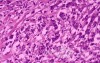 Diffuse Adenocarcinoma with signet ring cells (18 of 18)