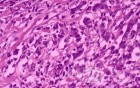Diffuse Adenocarcinoma with signet ring cells (18 of 18)
