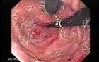 Adenocarcinoma of the Gastroesophageal Junction - Two Endoscopes in Retroflexed View