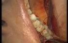Reconstruction Of Adhesive Gingiva (5/5)