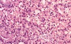 Gastric Cancer (14 of 15)