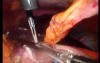 Gastrointestinal Stromal Tumor - GIST (43 of 65)