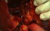 Splenectomy video