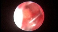 Semi-Rigid Ureteroscopy - Stone Removal