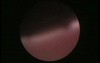 Hysteroscopic Examination of Uterus - Presence of Mucous Polyp