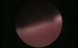 Hysteroscopic Examination of Uterus - Presence of Mucous Polyp