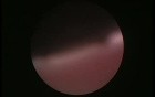 Hysteroscopic Examination of Uterus - Presence of Mucous Polyp