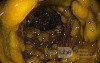 Endoscopic appearance of the Pseudomembranous colitis