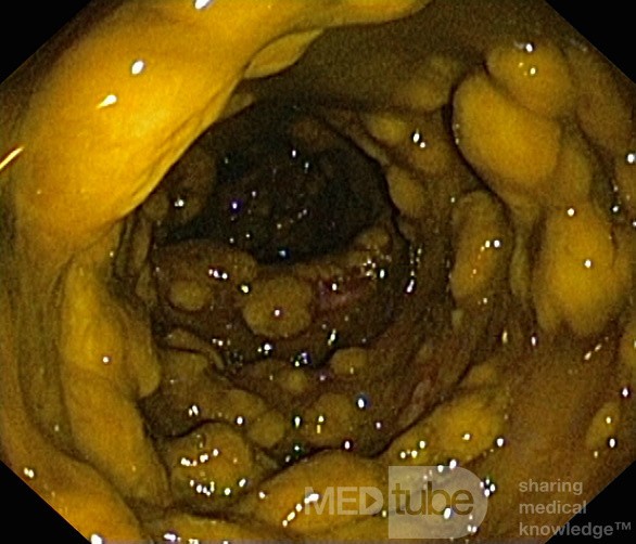 Endoscopic appearance of the Pseudomembranous colitis