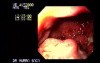 Gastric Adenocarcinoma - Gastroscopy
