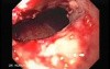 Synchronous Cancer Gastric and Esophageal (7 of 9 )