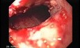 Synchronous Cancer Gastric and Esophageal (7 of 9 )