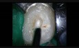 Access Cavity Walls Refinement