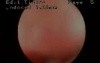 Hysteroscopic Aspect Of Endometrial Atrophia