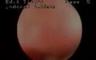 Hysteroscopic Aspect Of Endometrial Atrophia