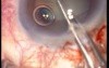 Phacoemulsification - Complications