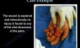 Median nerve endangered by a foreign body 