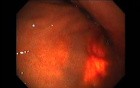 Gastrointestinal Stromal Tumor - GIST (15 of 65)