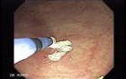 Multiple Gastric Angiodysplasia (16 of 17)