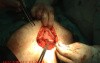 Cesarean Section - Closing Technique