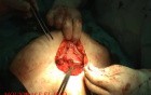 Cesarean Section - Closing Technique