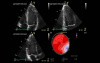 Calculation of Left Ventricle Ejection Fraction - Value of Global Area Strain.