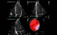 Calculation of Left Ventricle Ejection Fraction - Value of Global Area Strain.