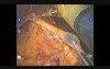 Robotic Total Gastrectomy  