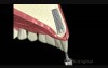 Dental Implant