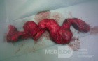 Aneurysm Of Arteriovenous Fistula